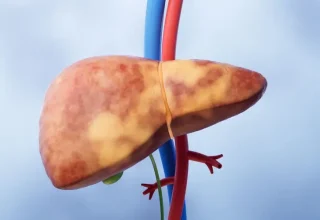 Karaciğer Yağlanması Hızla Artıyor