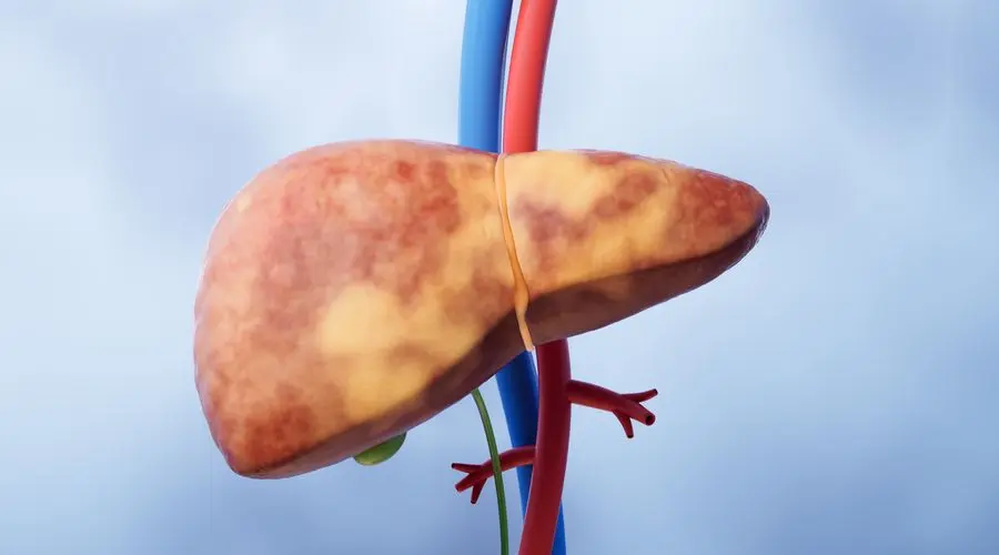 Karaciğer Yağlanması Hızla Artıyor